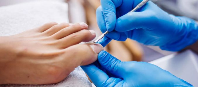 Грибок нігтів на ногах: симптоми, стадії та лікування без таблеток