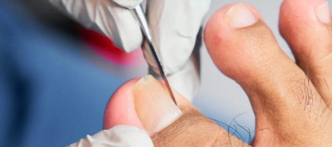 Врослий ніготь: чому болить, чим небезпечний і як позбутися назавжди