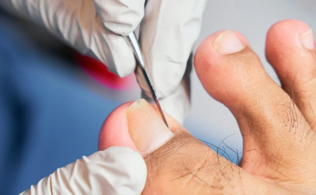 Врослий ніготь лікування