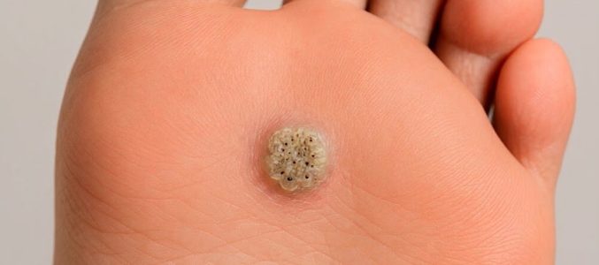 Бородавки на ногах: чому з’являються і як позбутись назавжди