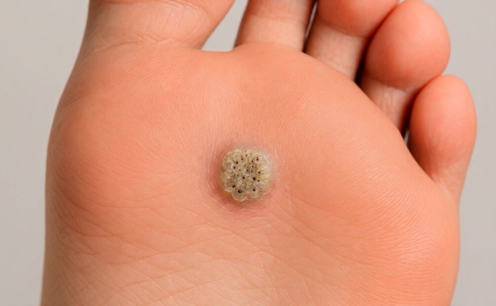 Бородавки на ногах: чому з’являються і як позбутись назавжди
