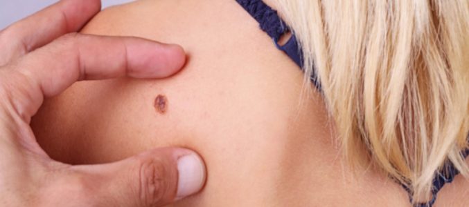 Невус (родимка): видалення безпечно та без рубців