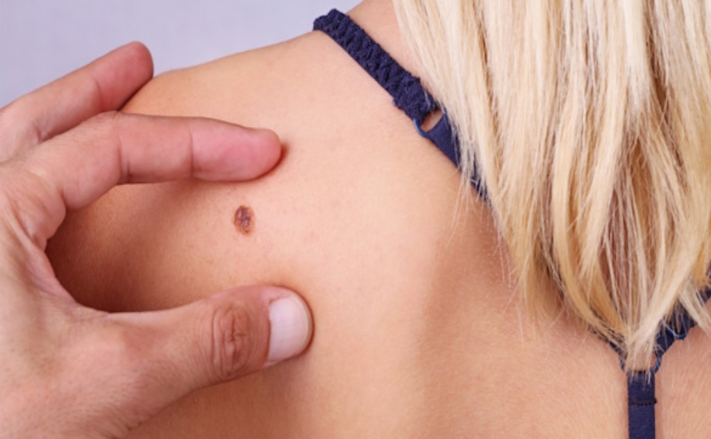 Невус (родимка): видалення безпечно та без рубців