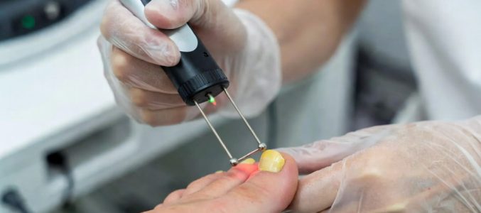Лікування грибка нігтів лазером: як працює метод насправді